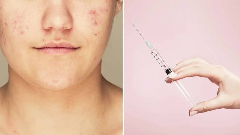 sivilceye karsi iki asi gelistiriliyor mrna denemesi ve enzim hedefli yaklasim vFtUCnlR